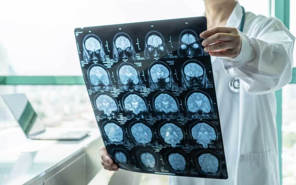 Medical scan of a patients brain being held up by doctor.