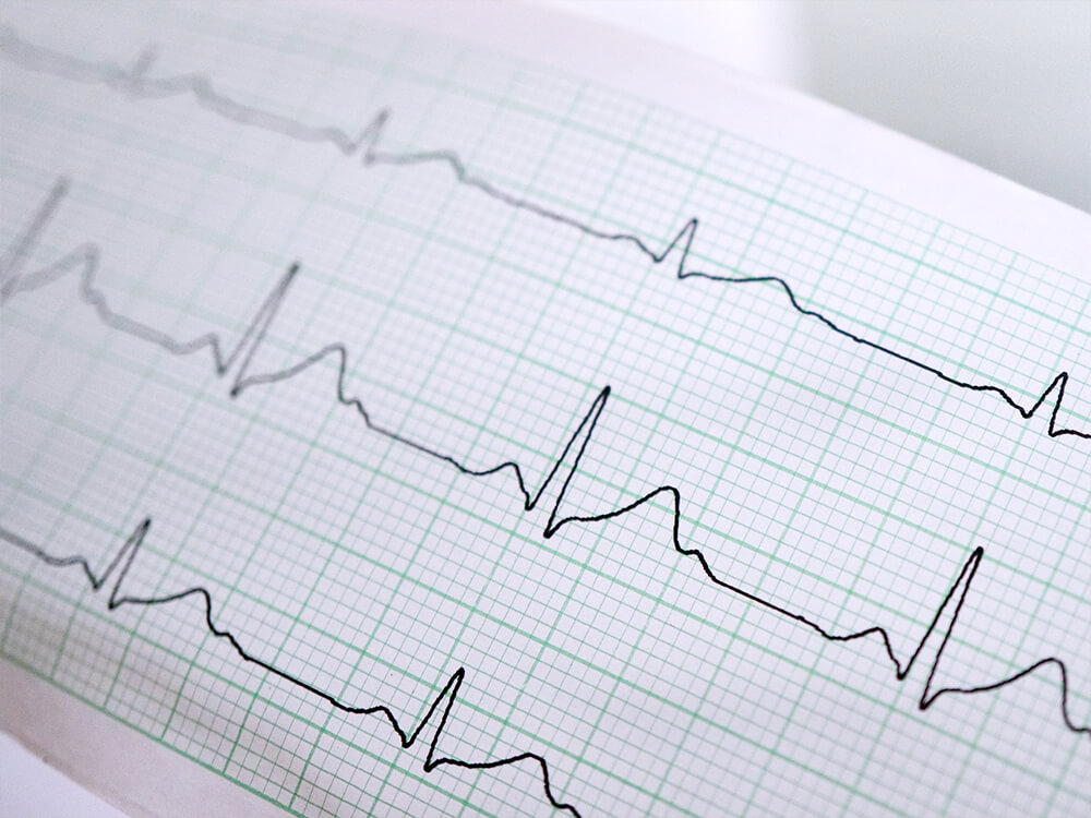 Printed electrocardiograph scans